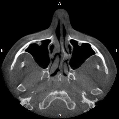 Cross-section of my deviated septum, from below